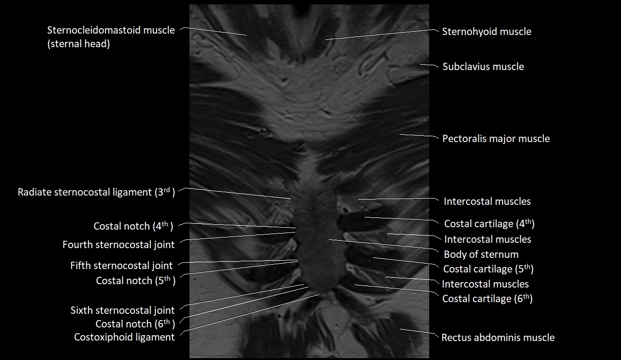 MRI sternum and sternoclavicular joint labeled coronal anatomy image 5.webp